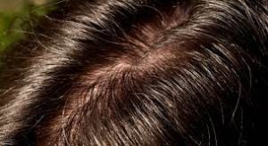 What Causes an Oily Scalp - How to Manage an Oily Scalp