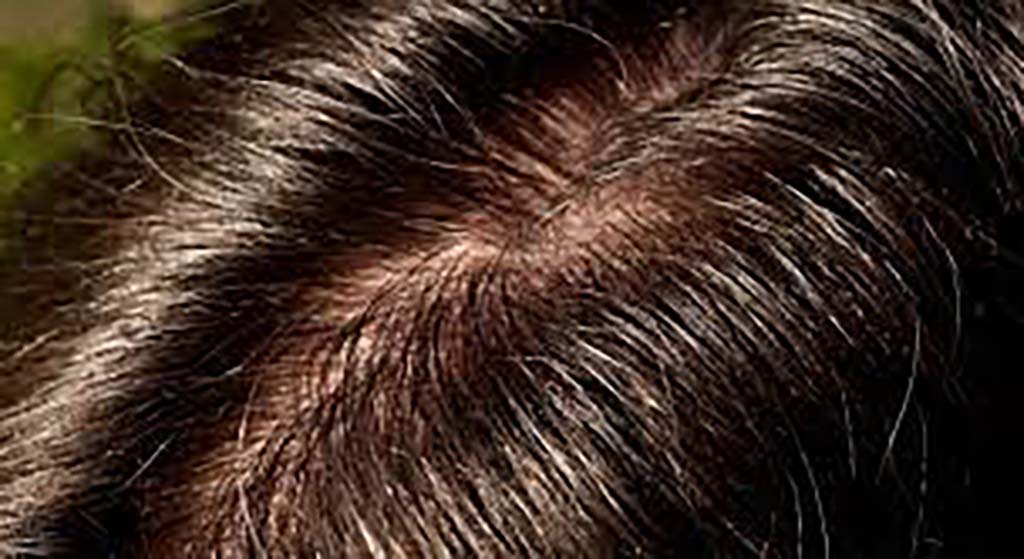 Oily Scalp Causes & Solutions