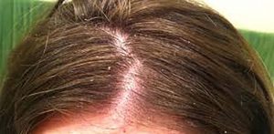 Dry Scalp Causes & Solutions