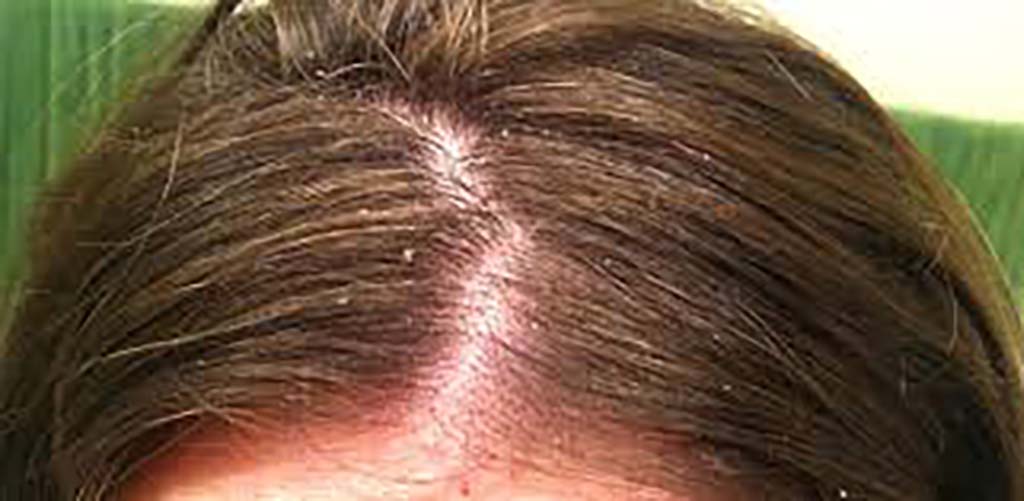 Зуд выпадение волос причины. Себорейный дерматит на голове. Себорея волосяного Покрова.